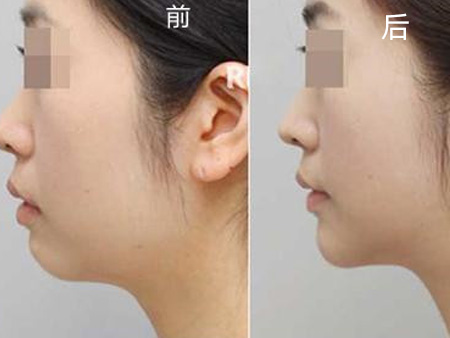 下巴填充對(duì)比